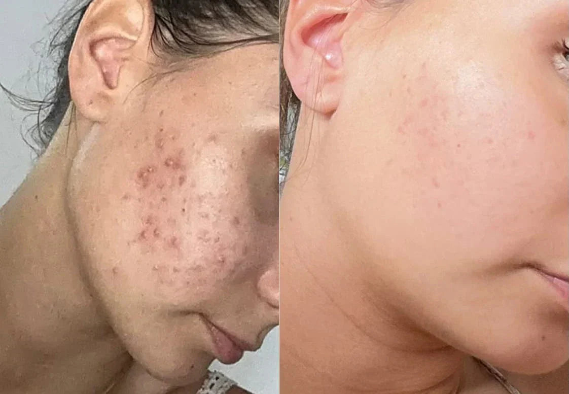 Curcuma et hyperpigmentation : comment agit-il vraiment sur les taches brunes ? Image